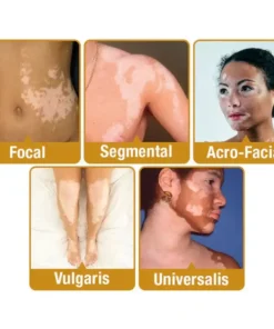 Bee Venom VitiGO Correcting Cream
