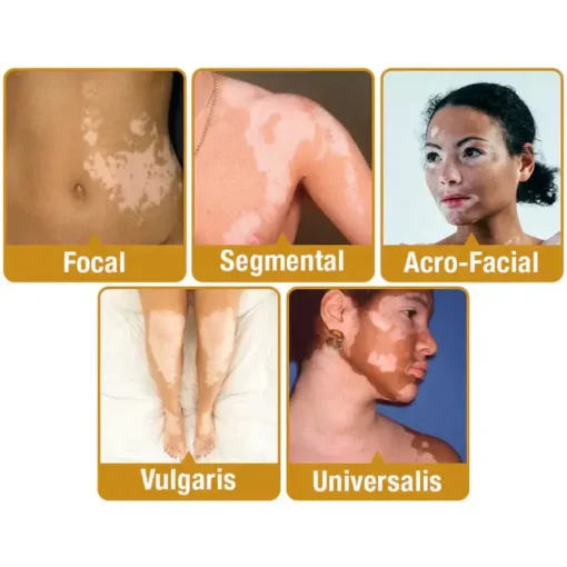 Bee Venom VitiGO Correcting Cream