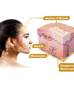 Bee Venom VitiGO Correcting Cream