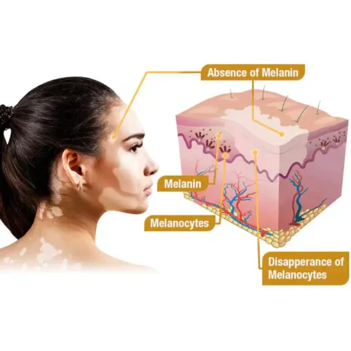 Bee Venom VitiGO Correcting Cream
